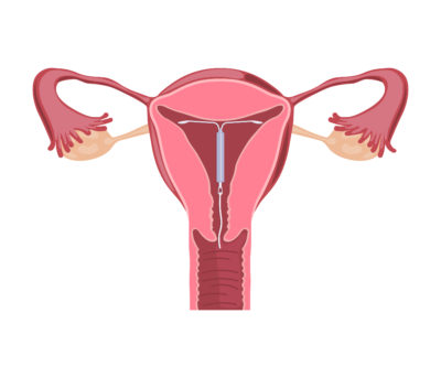 uregelmæssig menstruation i overgangsalderen