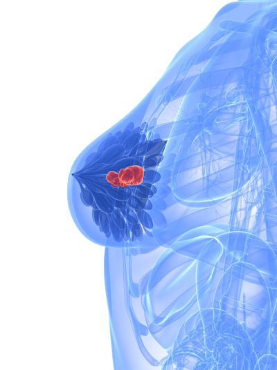 hormonspiral og øget risiko for brystkræft